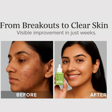 Blushlin Salicylic Acid Serum 2% with Neem, Tea Tree & Ceramidine | Fights Acne, Clears Blackheads, Controls Oil