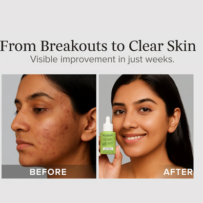 Blushlin Salicylic Acid Serum 2% with Neem, Tea Tree & Ceramidine | Fights Acne, Clears Blackheads, Controls Oil
