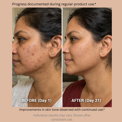 Blushlin Tranexamic acid serum for melasma, pigmentation & PIE